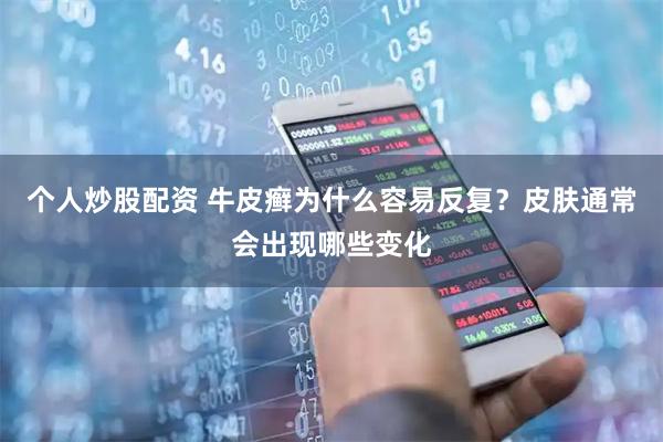 个人炒股配资 牛皮癣为什么容易反复？皮肤通常会出现哪些变化